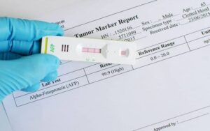 معلومات عن تحليل AFP دلالاته وعلامات الأورام